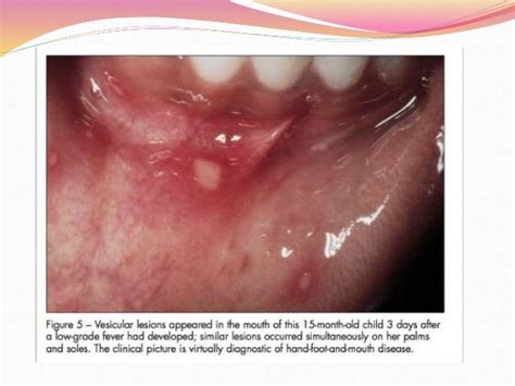 Oral Manifestations Of Systemic Diseases