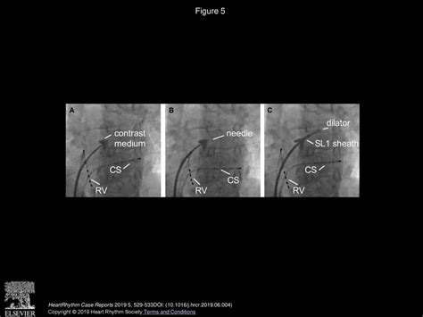 Complication Prevention In Ablation Procedures How To Perform