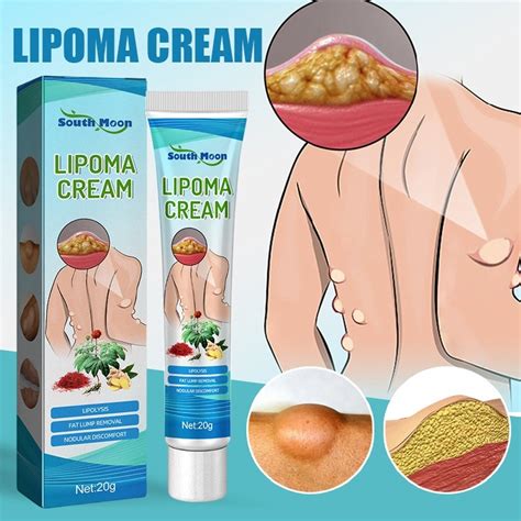 Jual South Moon Salep Lipoma Salep Benjolan Lipoma Cream Original