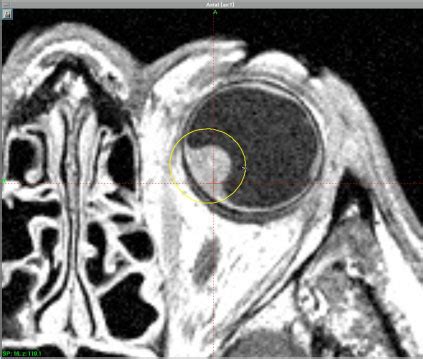 Melanoma Uveale Diagnosi Trattamento E Risultati