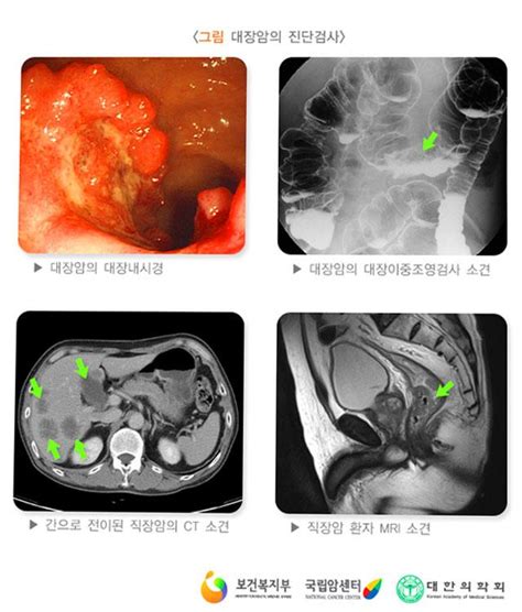 대장암증상 4기 말기 증상과 생존율은