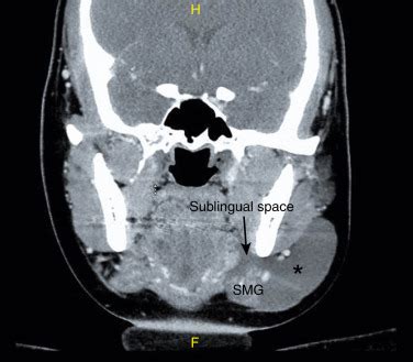 Surgical Management of Ranula | Ento Key