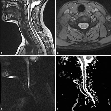 a T2-weighted sagittal MRI of the cervical spine. b T2-weighted axial... | Download Scientific ...