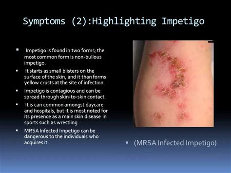 Methicillin Resistant Staphylococcus Aureus Mrsa Silvestri Youtube