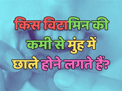 Trending Quiz किस विटामिन की कमी से मुंह में छाले होने लगते हैं