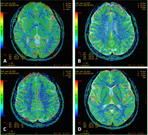 Perfusion Weighted MR Examination Regions Of Interest ROI On A