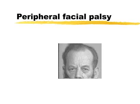 Ppt Bells Palsy Powerpoint Presentation Free Download Id3778395