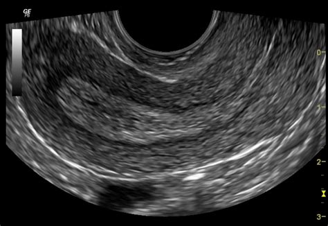 Normal Pelvic Ultrasound Transvaginal Image