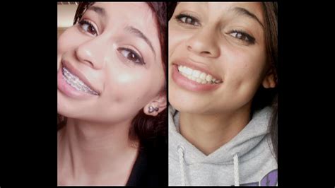 Before And After Braces: Buck Teeth Before And After Braces Pictures