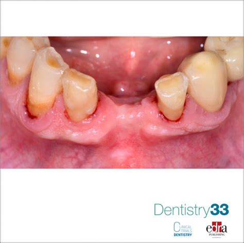 Dimensional Alterations In The Post Extraction Alveolar Process In The