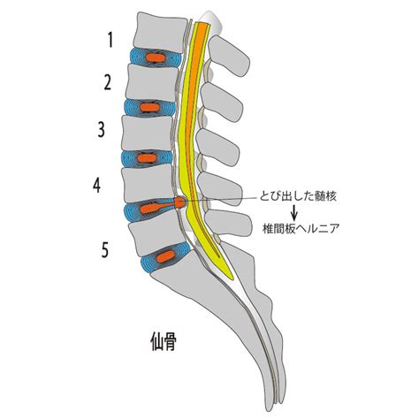 腰椎椎間板ヘルニア 整形外科の病気 どうやリハビリ整形外科