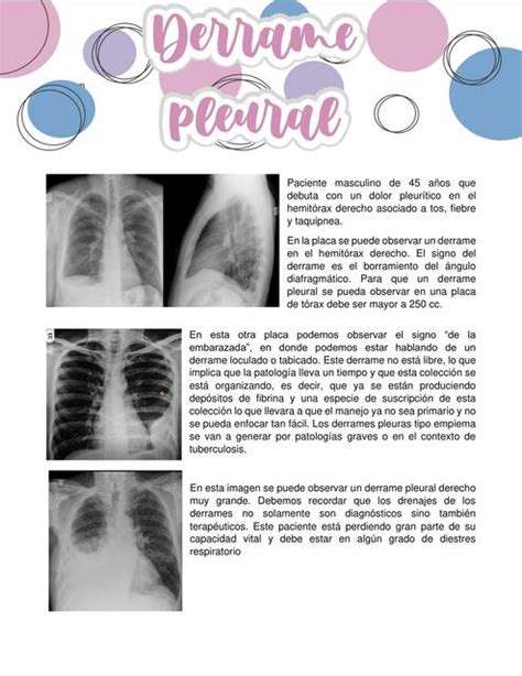 Derrame Pleural Juanita Zapata Udocz