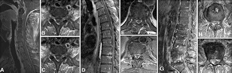 Case Preoperative T Weighted Mri Sequences With Gd Enhancement Of