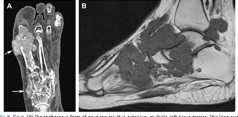 Figure From Imaging Of Soft Tissue Lesions Of The Foot And Ankle