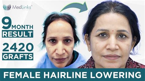 💹 Female Hairline Lowering Procedure At Medlinks Female Hair