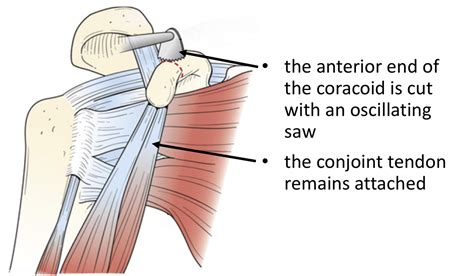 Instabilitydislocation Cambridge Shoulder