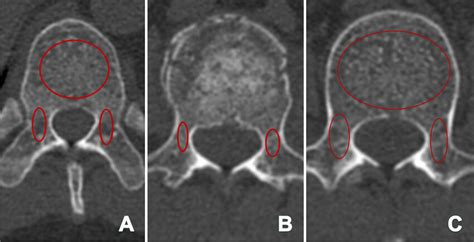 Measurement Methods For Mean CT Hounsfield Unit HU Values A