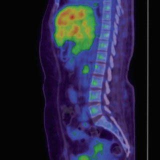 Whole Body Flourine Fluorodeoxyglucose Positron Emission