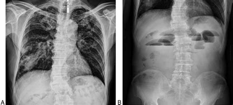 Plain X Rays Of Chest And Abdomen On Hospital Admission A Chest