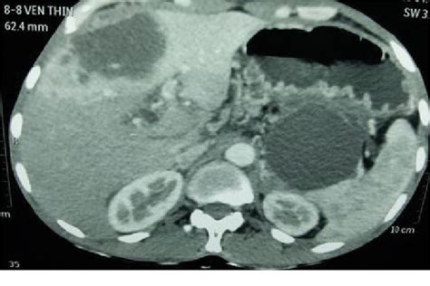 Figure 2 From Pancreatic Ductal Adenocarcinoma With Cystic Changes