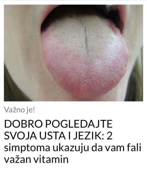 Dobro Pogledajte Svoja Usta I Jezik Simptoma Ukazuju Da Vam Fali