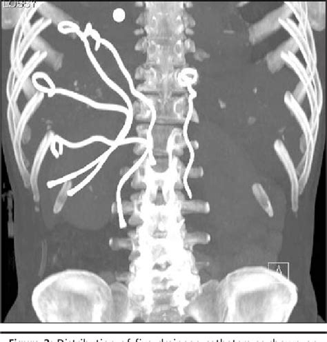 Figure 2 From An Unusual Presentation Of Amebic Liver Abscesses Semantic Scholar