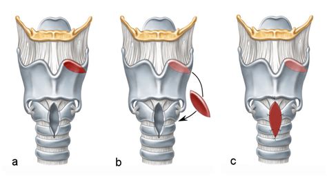 Laryngotracheal Reconstruction With Autogenous Thyroid Cartilage