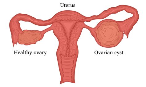 Ovarian Cysts Symptoms And Treatment Health And Glow 2H Fit