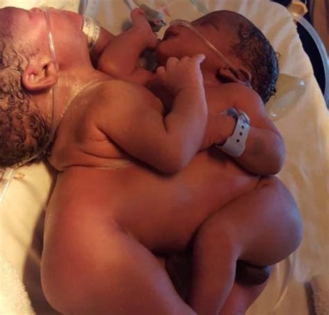 Photo Woman Gives Birth To Conjoined Twins With Two Hearts And One