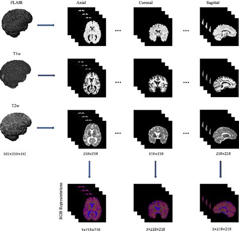 Figure 1 1 From Deep Learning Approaches For Segmentation Of Multiple Sclerosis Lesions On Brain