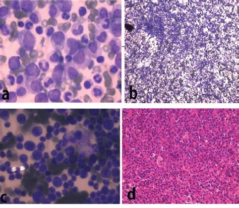 Figure A Peripheral Smear Showing Myeloid Hyperplasia With