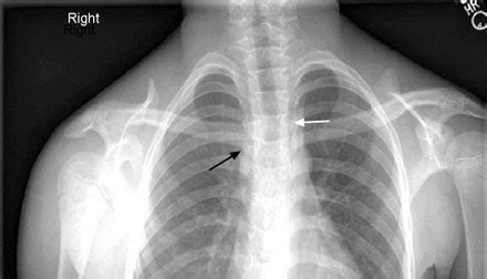 Sternoclavicular Dislocation - Trauma - Orthobullets