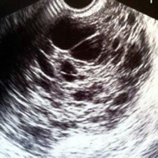 Endovaginal pelvic ultrasound: axial view: Adnexal mass measuring ...