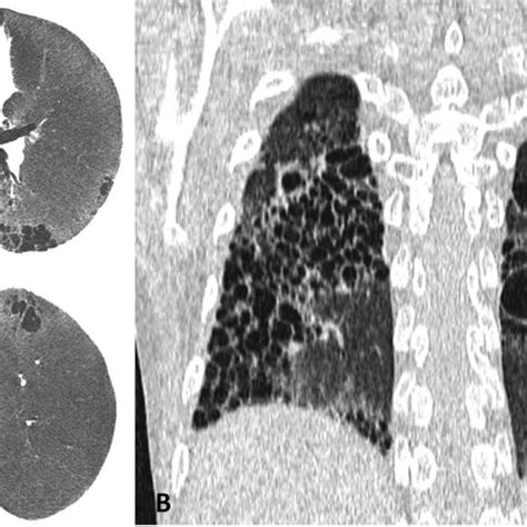 High‐resolution Computed Tomography Of The Chest Axial Image A With