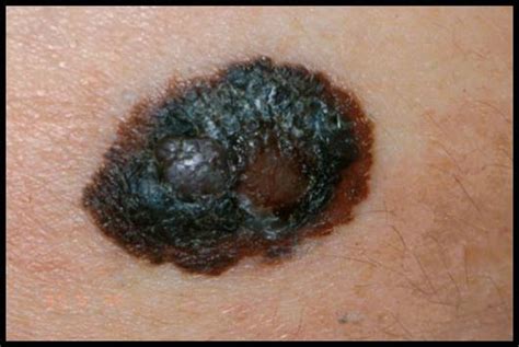 23 De Mayo Día Mundial Del Melanoma Dermik