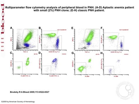 Multiparameter Flow Cytometry Analysis Of Peripheral Blood In Pnh