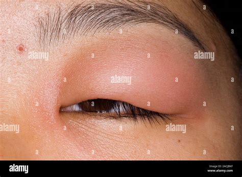 Close Up Of The Red And Inflamed Eyelid In A 24 Year Old Female Patient