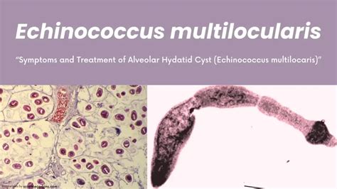 Echinococcus Multilocularis The Alveolar Hydatid Cyst Threat 2024