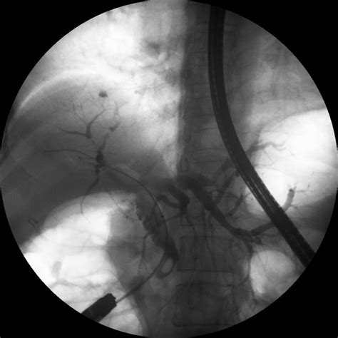 A Balloon Occlusion Cholangiogram Showing A Distal Common Bile Duct Download Scientific Diagram