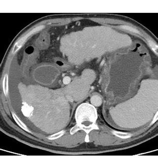 Abdominal Enhanced Computed Tomography Images A Plain CT Scan B