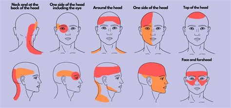 Cefalea Migraña Jaqueca Generalidades y tratamientos Neuromed