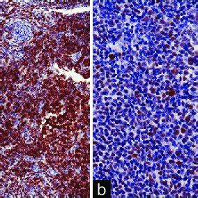 Immunohistochemical Staining For Cd Showing Diffusely Positive