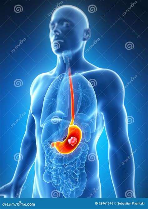 Stomach Cancer. Cross Section Of The Stomach Vector Illustration