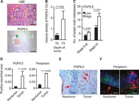 PGP9 5 And Peripherin May Represent Neural Markers For Gastric Cancer