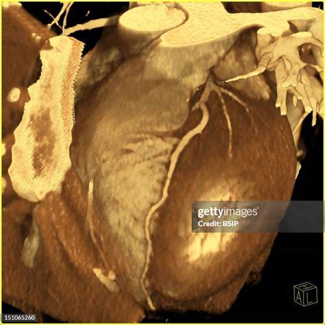 coronary artery scan stock  high res pictures  images