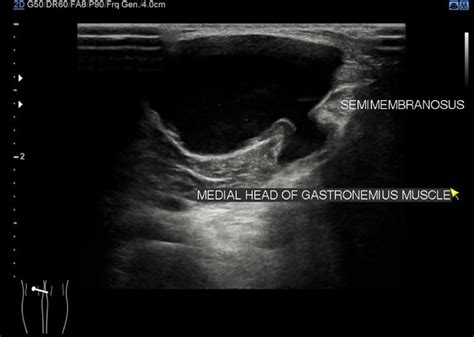 View Baker S Cyst Knee Ultrasound