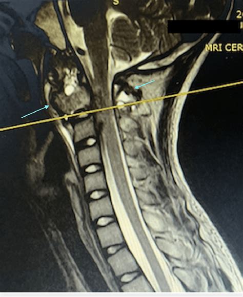 Sagittal MRI of the cervical spine This is the MRI from the time of... | Download Scientific Diagram