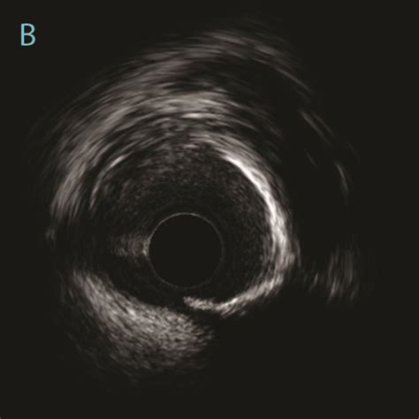 Impact Of Intravascular Imaging On Pci Murmurs National Heart Centre