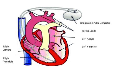 Permanent Pacemaker Implantation