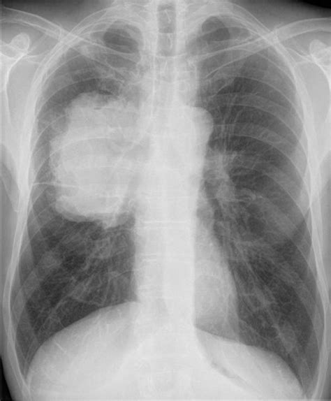 Pneumologie unsere Krankheitsbilder im Röntgenbild